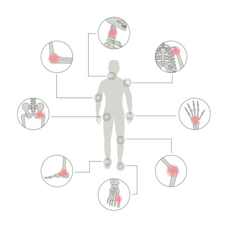Arthritis Disease Vector Illustrationのイラスト素材