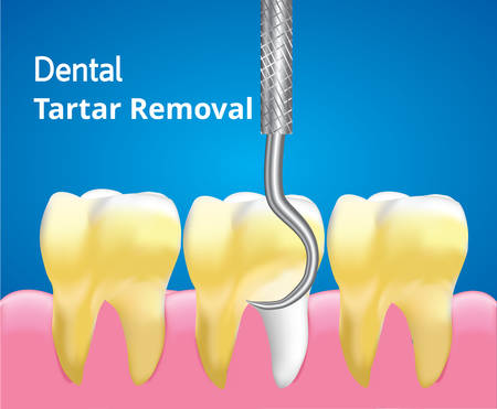 Scaling Tartar and Cleaning teeth, Dental care concept, Realistic design illustration Vector.のイラスト素材