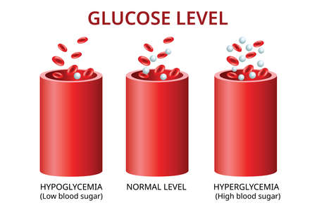Glucose level in the blood vessel, normal level, hyperglycemia (high blood sugar), hypoglycemia (low blood sugar) Vector Illustrationのイラスト素材