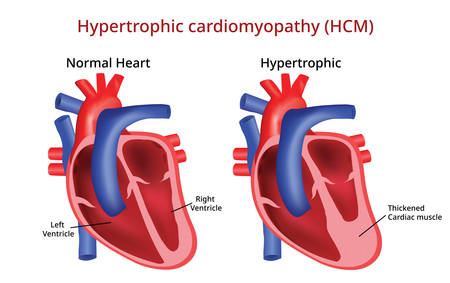 Hypertrophic cardiomyopathy, Heart diseaseのイラスト素材