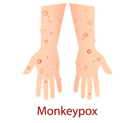 Monkeypox virus  that can infect human,  Monkey pox. Vector illustrationのイラスト素材