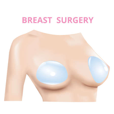 Breast implant, Silicone insert, Plastic surgery, 3D Realistic design Vector.のイラスト素材