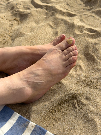 Close up of female feet on sandy beach showing damaged toenail. Concept of foot health, nail...