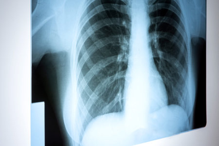 X-ray of the lungs. Chest x-ray. Check the lungs in the hospital on a reflective board to view...