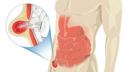 Stomach Pain Hernia, illustrationの写真素材