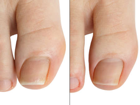 Deleting cuticle nail beauty salon befor and after. Isolated on white background.の写真素材
