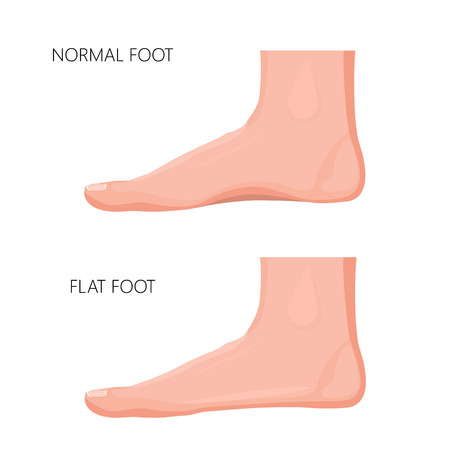 Realistic illustration of a normal foot and a flat foot.のイラスト素材