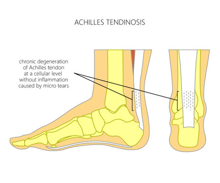 Illustration of Skeletal ankle (side view and back view) with tendinosis of Achilles tendon.のイラスト素材