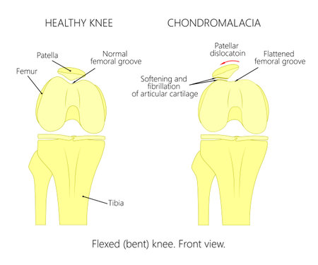 Illustration (diagram) of normal knee joint and a knee with chondromalacia patella. Flexed (bent) knee. Front view.のイラスト素材