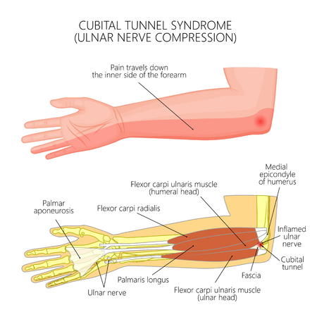 Illustration of Cubital tunnel syndrome or ulnar nerve impingement.  Used: Gradient,  transparency, blend mode.のイラスト素材