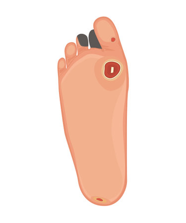 Vector illustration of an Ischemic and neuropathic Diabetic Foot with gangrene of the toes of the foot and ulcers on the sole of the foot. Used: transparency, blend modeのイラスト素材