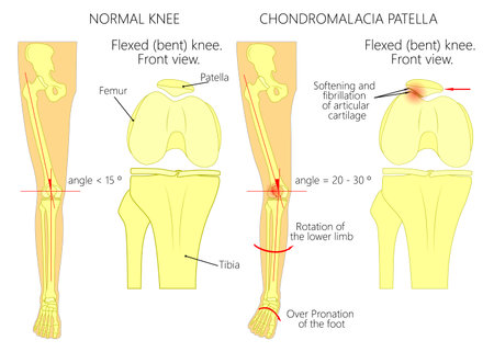 Illustration (diagram) of normal leg with a healthy knee and a leg with over pronation of the foot arch and chondromalacia patella. Used: gradient, blend mode, transparency.のイラスト素材