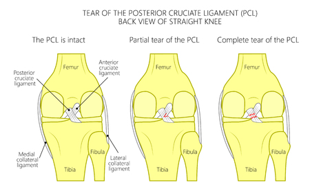 Vector illustration of healthy knee joint with intact ligaments, partial tear of posterior cruciate ligament, complete tear of PCL. Posterior view of straight knee. For medical publications. EPS 10.