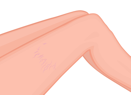 Vector illustration of a human body problem. Varicose and spider veins on woman leg. For advertising and medical publications. EPS 8.のイラスト素材