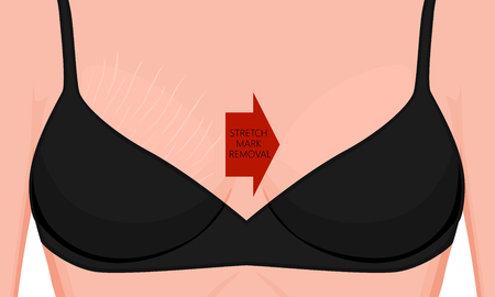 Vector illustration of a human body problem. Stretch marks removal on European, Asian female or woman breast. For advertising, medical publications, use on package of medicinal products, creams. EPS 8のイラスト素材
