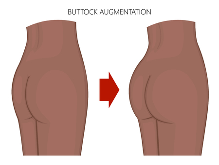 Vector illustration Woman body. African American Indian female naked buttocks before, after augmentation. For advertising of cosmetic procedures, clinic of plastic surgery, medical publications.のイラスト素材
