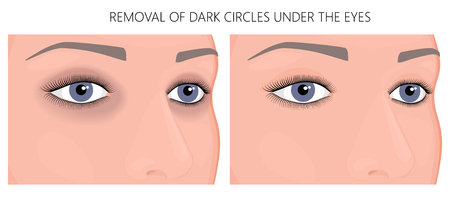 Vector illustration. Female eyes with dark circles around the eyes and without dark circles. For advertising funds for the treatment of this problem and medical publications about it.のイラスト素材