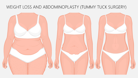 Vector illustration. Weight loss, abdominoplasty, tummy tuck plastic surgery in woman. Front view. For advertising of cosmetic plastic procedures, stomach shunting, diet; medical publications.のイラスト素材