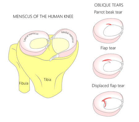 Vector illustration. Anatomy of a meniscus in the healthy human knee joint. Oblique  meniscal tears with cross section of the menisci. For advertising, medical publications. EPS 10.