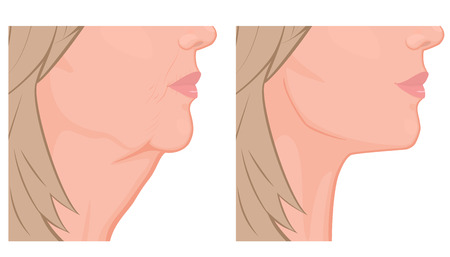 Vector illustration. A female face before, after plastic surgery - facial rejuvenation, face lift. Close up view. For advertising of cosmetological procedures, medical and beauty publications. EPS 10.のイラスト素材