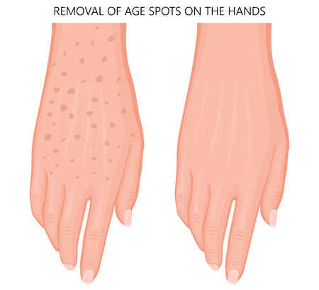 Vector illustration of a human hand with age spots before and after removal. Dorsal view. For advertising, medical publications. EPS 10のイラスト素材