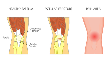 Vector illustration of a healthy knee joint and an unhealthy knee with displaced fracture of the patella. Anatomy, front view of the human knee. For advertising and medical publications. EPS 10.のイラスト素材