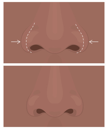 Vector illustration. Front view of a wide human nose before, after aesthetic plastic surgery - rhinoplasty (nose job). Close up view. For advertising, medical and beauty publications.のイラスト素材