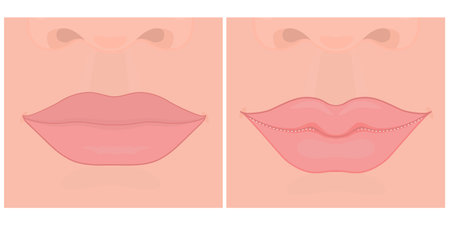 Korean Cupid plastic surgery or lip tip plastic surgeryのイラスト素材