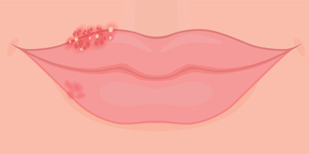 Vector illustration. Close up view of herpes virus problem on the lips. For use on herpes medication packaging and medical articlesのイラスト素材