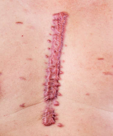 big swell cicatrix - hypertrophic scarの写真素材