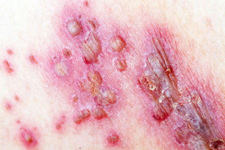 Detail of skin with Herpes Zoster Shinglesの写真素材