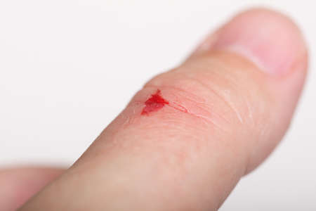 disinfect the scratch by rubbing in alcohol cuts on the handの写真素材