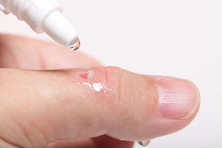 disinfect the scratch by rubbing in alcohol cuts on the hand