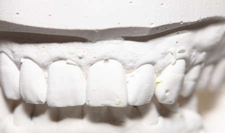 Dental casting gypsum model plaster cast stomatologic human jaws prothetic laboratory, technical shotsの写真素材