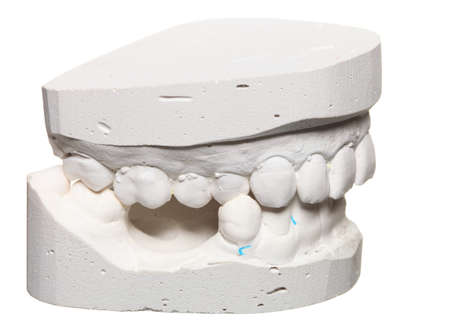 Dental casting gypsum model plaster cast stomatologic human jaws prothetic laboratory, technical...