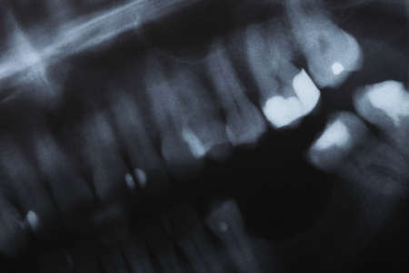 detail x-ray image scan of humans teethの写真素材