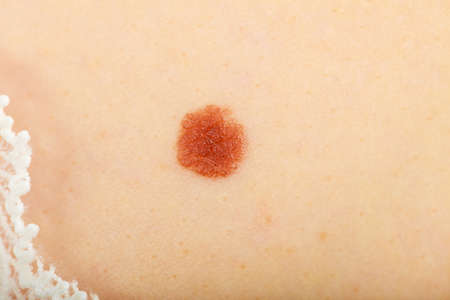 Skin disease. Closeup brown mole on caucasian human body.