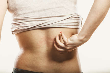Human scratching itchy sore back skin. Allergy rash. Health problem.