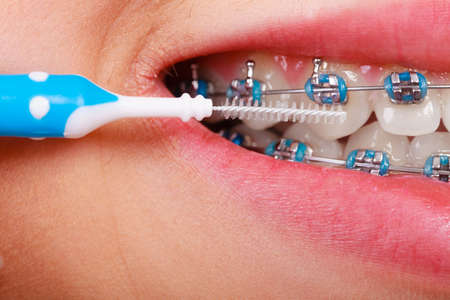 Dentist and orthodontist concept. Young woman cleaning and brushing teeth with blue braces using toothbrushの写真素材