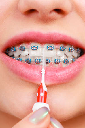 Dentist and orthodontist concept. Young woman cleaning and brushing teeth with blue braces using...
