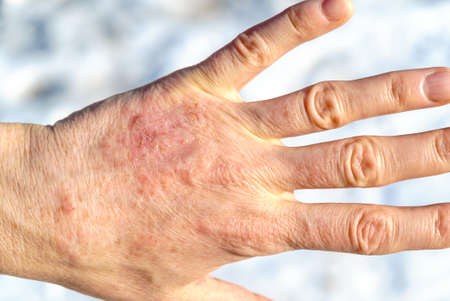 Detailed closeup of dry mature woman hand. Hand care and dermatology problems concept.