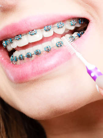 Dentist and orthodontist concept. Young woman cleaning and brushing teeth with blue braces using toothbrushの写真素材