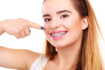 Dentist and orthodontist concept. Young woman smiling showing teeth with blue bracesの写真素材