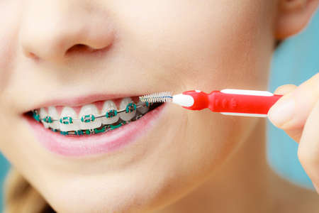 Dentist and orthodontist concept. Young woman with blue braces cleaning and brushing teeth using little toothbrush, interdental brushの写真素材