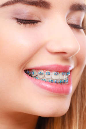 Dentist and orthodontist concept. Young woman smiling showing teeth with blue bracesの写真素材