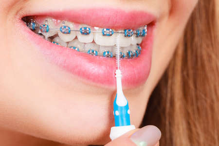 Dentist and orthodontist concept. Young woman cleaning and brushing teeth with blue braces using...