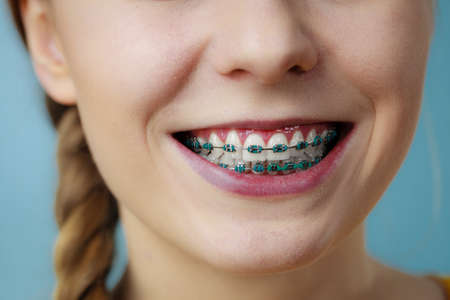 Dentist and orthodontist concept. Closeup of woman smile showing teeth with blue bracesの写真素材