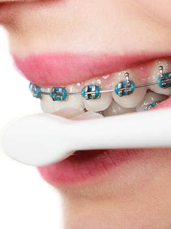 Dentist and orthodontist concept. Young woman cleaning and brushing teeth with blue braces using...