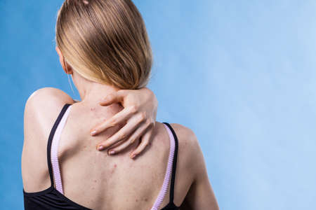 Teen girl scratching her shoulder with pimples.の写真素材