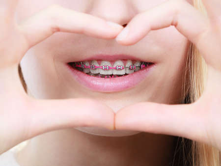 Orthodontist dentistry treatment concept. Happy smiling woman showing her dental braces on teethの写真素材